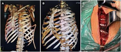 Evaluation of surgical outcomes in elderly patients with rib fractures: A single-centre propensity score matching study